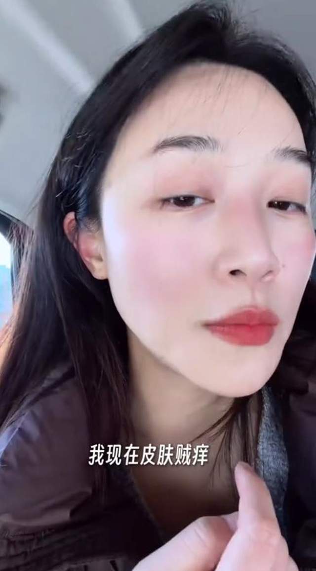 原創(chuàng)藍(lán)盈瑩吉林游玩，零下24度戶外只待半個(gè)小時(shí)就被凍傷，臉又紅又腫