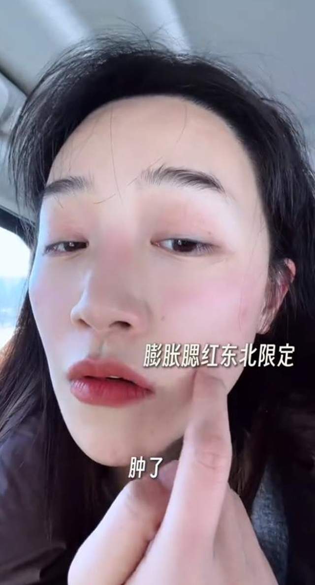 原創(chuàng)藍(lán)盈瑩吉林游玩，零下24度戶外只待半個(gè)小時(shí)就被凍傷，臉又紅又腫