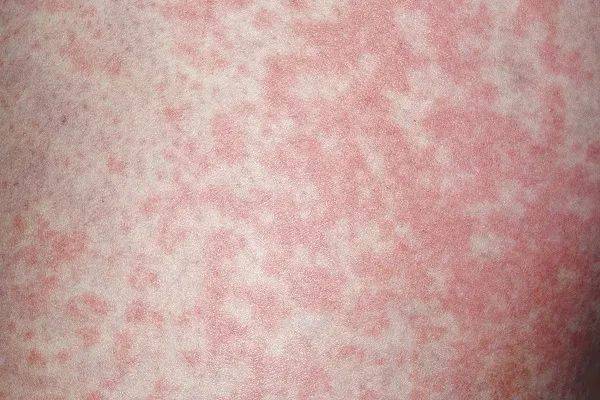 內(nèi)衣襪子混洗，男子確診感染！醫(yī)生: 這三件事要特別注意→