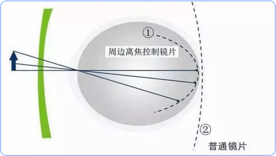 防控近視的離焦眼鏡有用嗎？