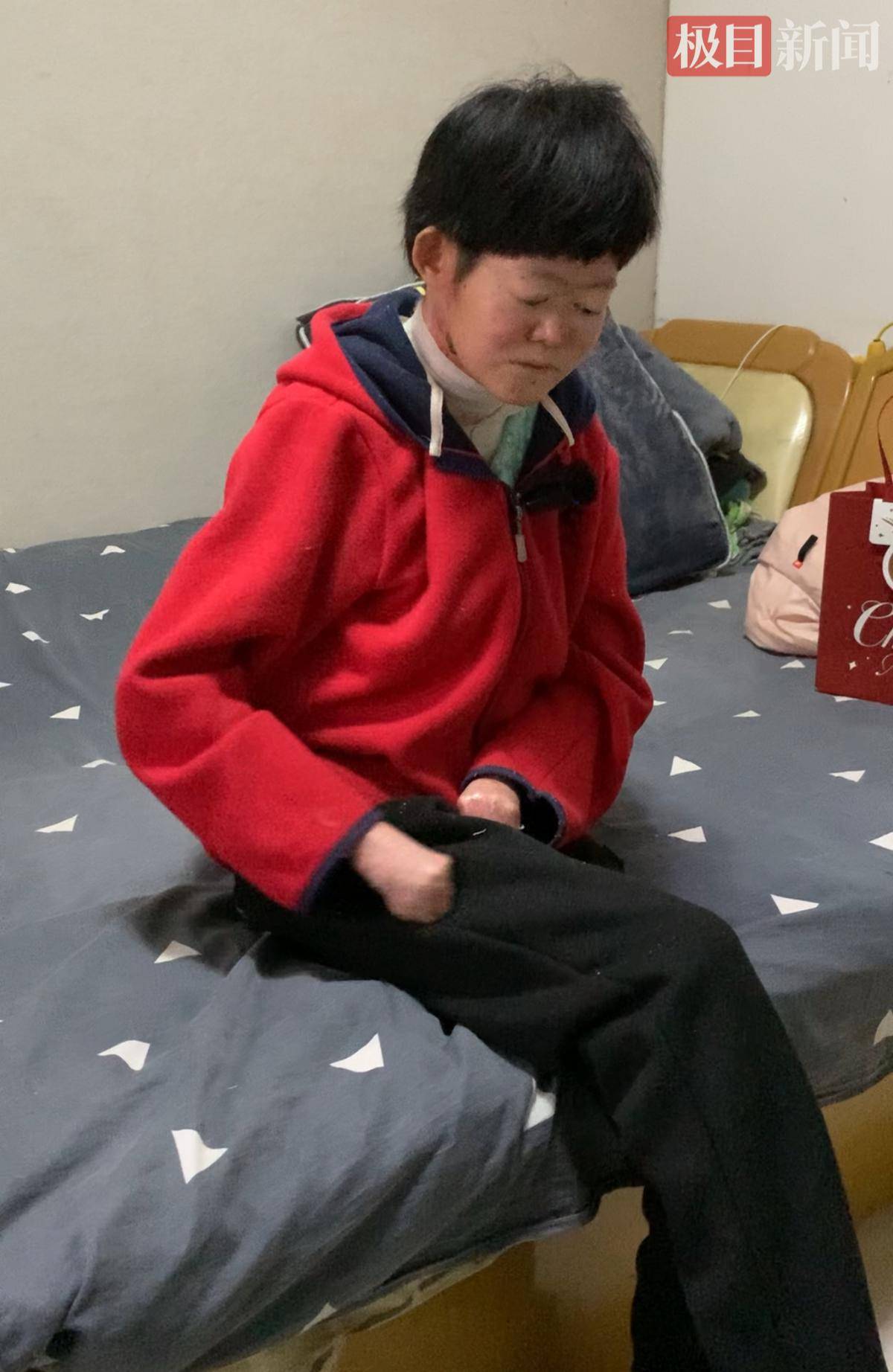 24歲“蝴蝶寶貝”小學(xué)成績曾名列前茅，初中畢業(yè)后身體無法支撐正常學(xué)習(xí)，曾一度癱瘓在床