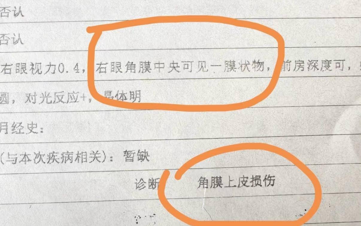 美睫需謹(jǐn)慎！網(wǎng)友嫁接睫毛后角膜上皮受損，醫(yī)生提醒愛(ài)美女性們避開這些坑