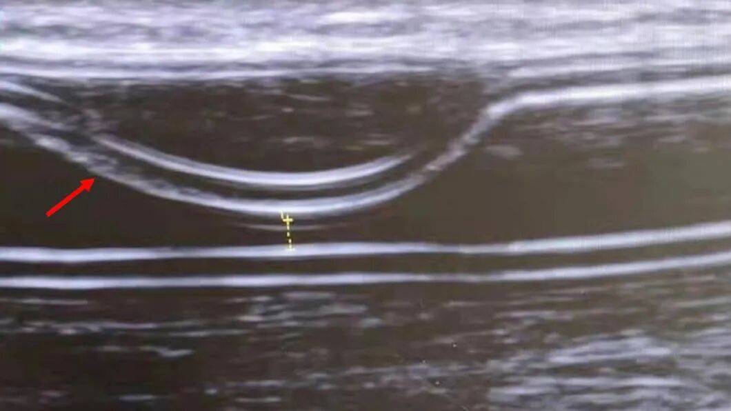 2026年首篇！我院腎臟內(nèi)科在國(guó)際血透期刊再次發(fā)表SCI論文