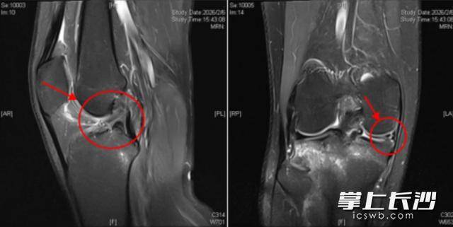 球場上急停變向，留學(xué)生膝關(guān)節(jié)“亮紅燈”！警惕這四類信號