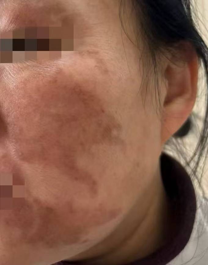 杭州41歲女子輕信美容院“快速祛斑”，結(jié)果變“花貓臉”！