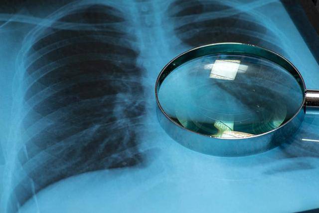 收藏！這4種癌癥早期篩查真的有用